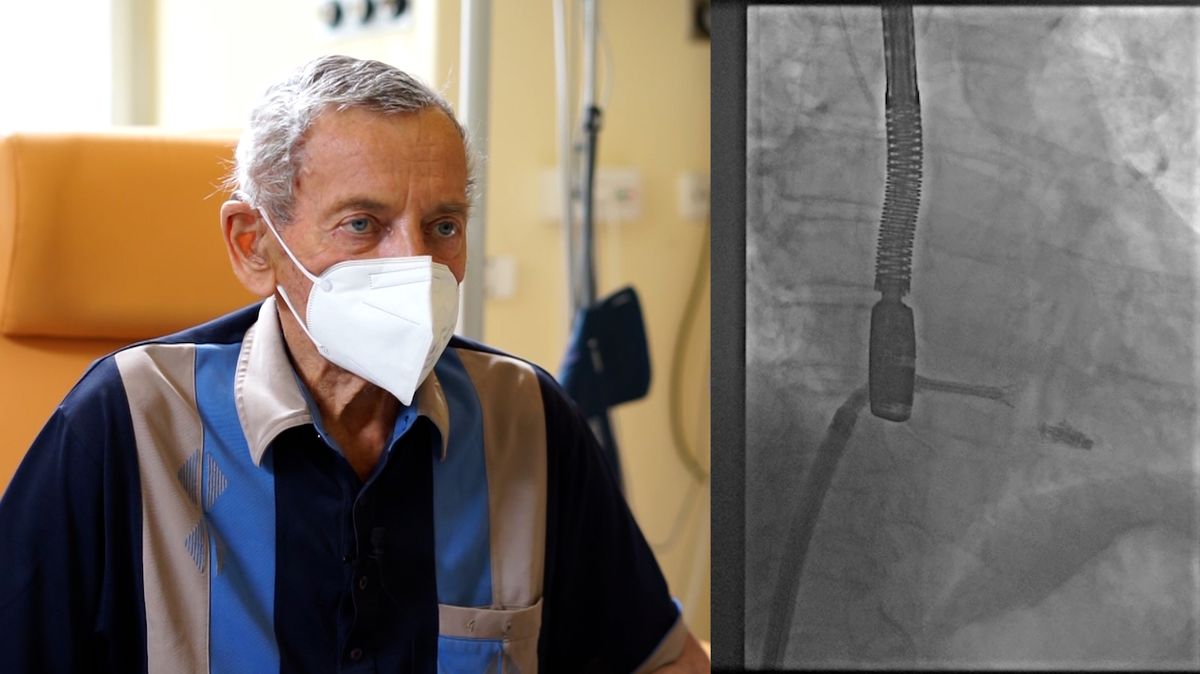 Čeští kardiologové poprvé provedli unikátní zákrok srdeční chlopně